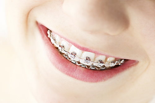 Dental Braces in Hanover Park, IL