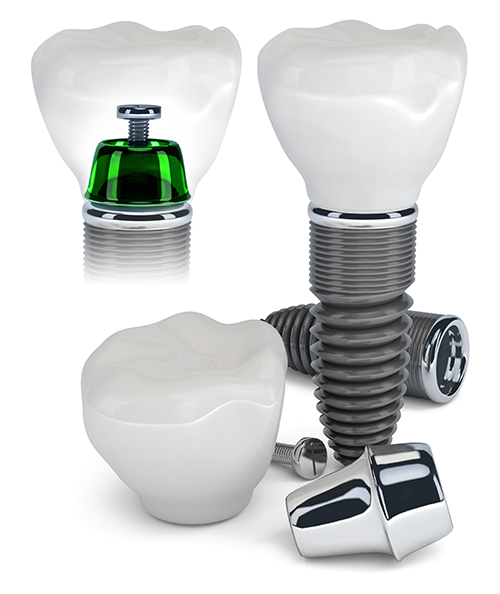 Dental Implants in Roselle, IL