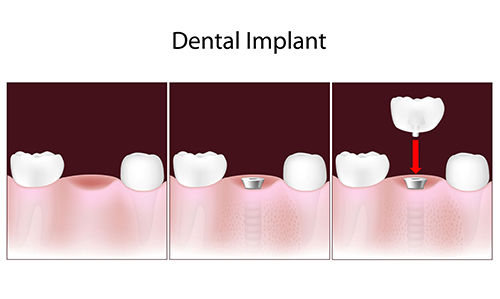 Dental Impants Hanover Park, IL